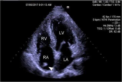 echocardiogram, in four-chamber apical view, showed an echogenic
