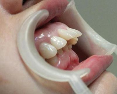 牙齿前突是什么原因造成的要怎么矫正价格是多少