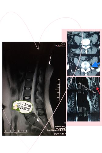 永福县中医医院成功开展首例腰椎间盘突出症微创侧孔镜手术