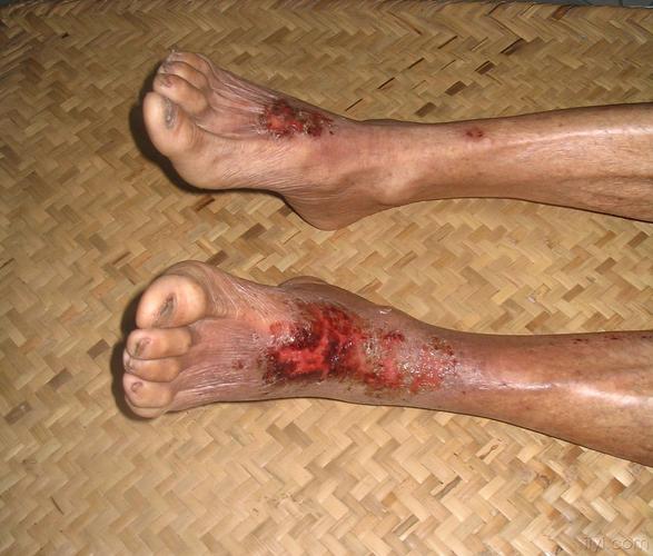 双下肢皮肤溃疡,瘙痒,疼痛,渗出1年(图片) - 皮肤及性传播疾病讨论版 