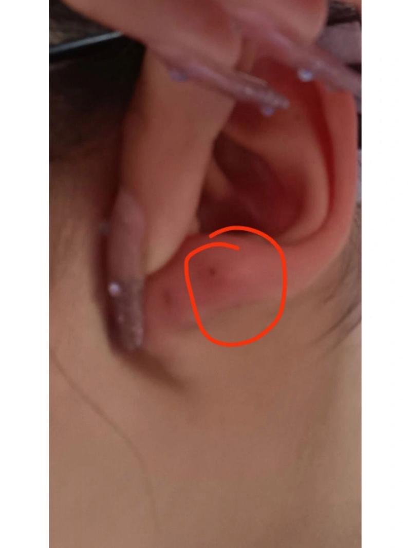 打耳洞快一个月了里面硬硬的不疼 左耳一直肿 画圈的是硬块最重的一个