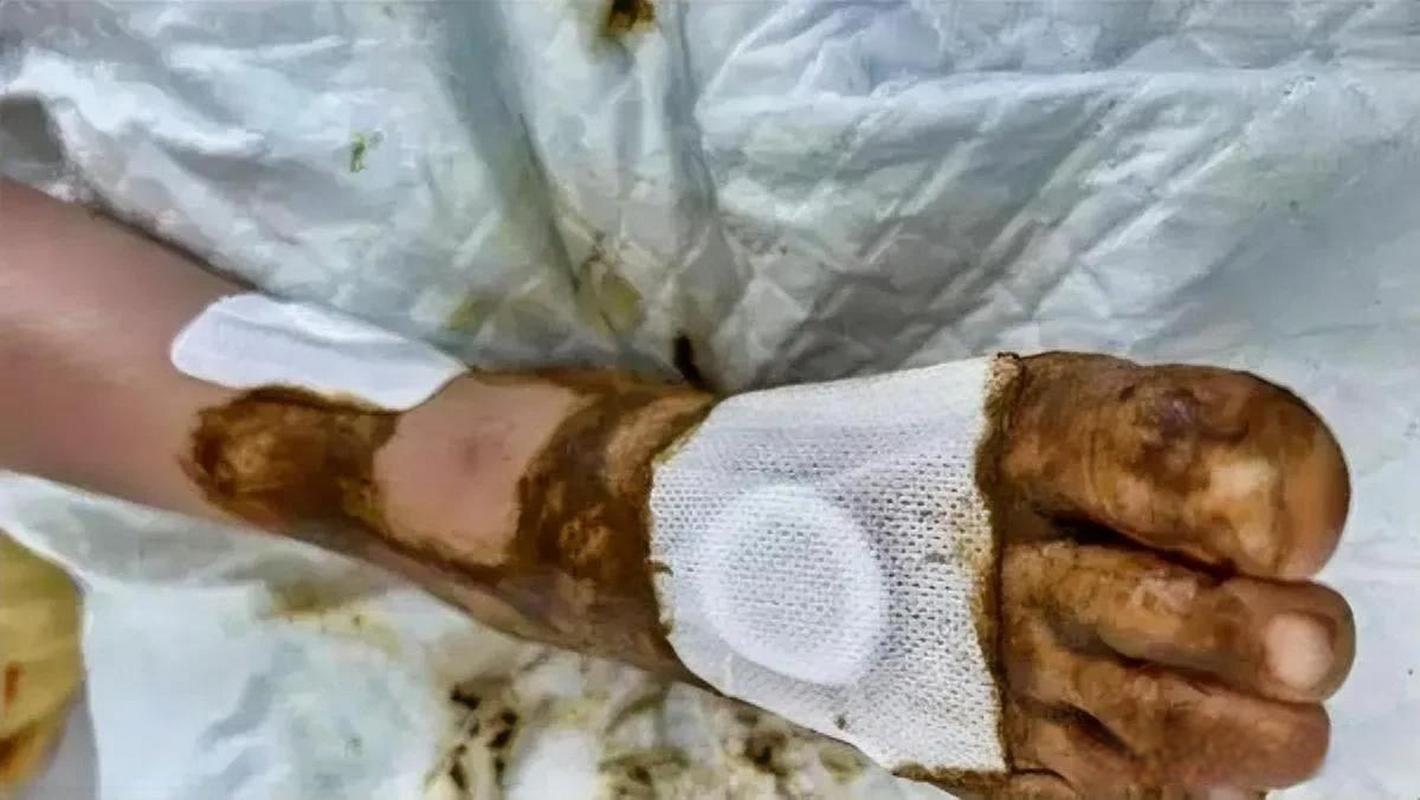 女童脚部被蜈蚣咬伤,奶奶用错误方法处理导致并发症严重 近日,福建