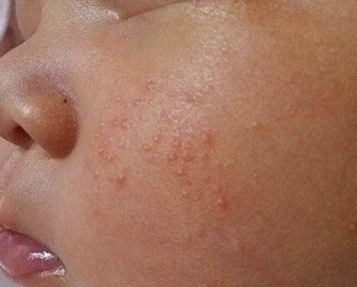 新生儿的28天:热疹,湿疹,胎毒,痤疮……,皮疹分得清吗?