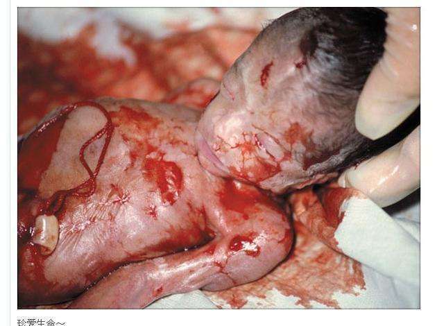 堕胎取出的东西,就像看到别人的儿子和女儿!_胎儿