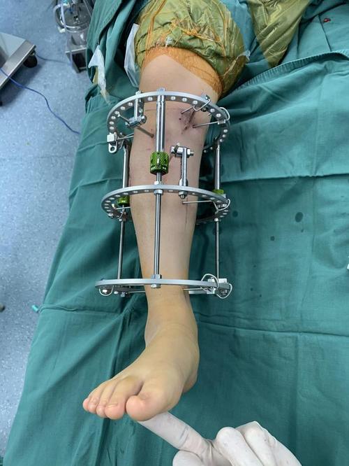 创伤性膝外翻畸形的手术矫正