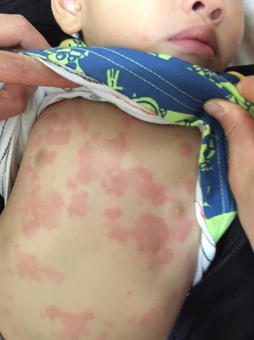 小孩1岁半了 从今年7月起一直反复荨麻疹～经常感冒