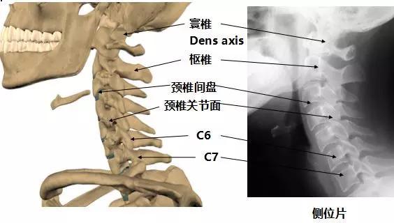 颈椎间盘退化,进而发生椎体骨质增生硬化,边缘骨赘形成,黄韧带肥厚及
