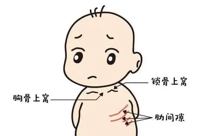 三凹征: 吸气困难时,宝宝胸部明显凹陷(胸骨上窝,锁骨上窝,肋间凹陷)