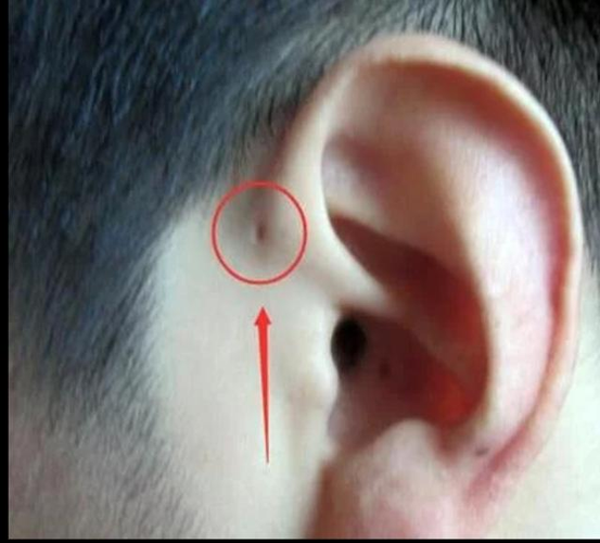 耳前小孔的秘密_先天性耳前瘘管_症状表现_治疗方式 - 好大夫在线