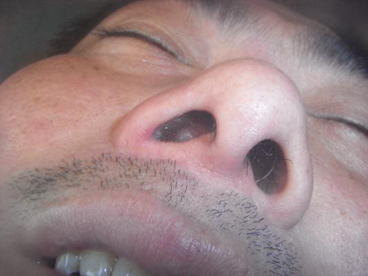 鼻窦炎症状图片 (44)
