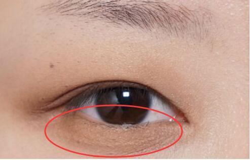眼睛凹陷是怎么回事眼睛凹陷的面相眼睛凹陷