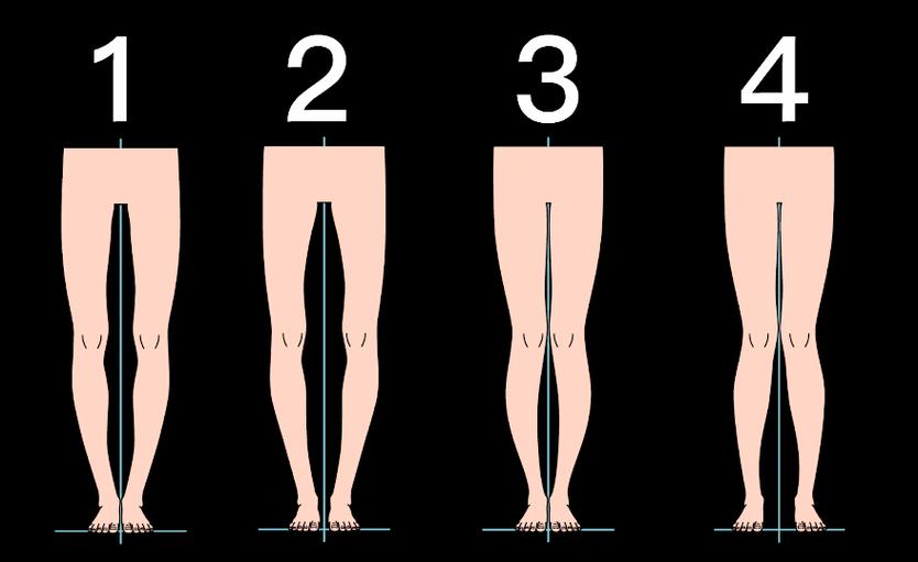小腿外翻怎样能使腿变直?小腿外翻是因为什么原因导致的?
