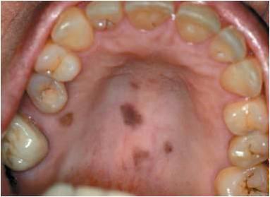 口腔黏膜常见黑色病变 - 春雨医生