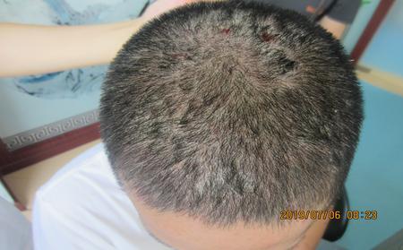 头皮银屑癣图片症状诊断及头皮银屑癣怎么治疗