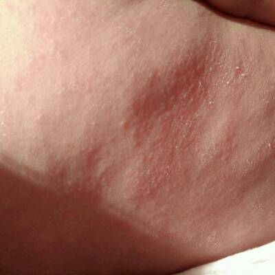 我家宝宝后背和胳膊都是这样的,皮疹上面还有鳞屑.这是湿疹吗?