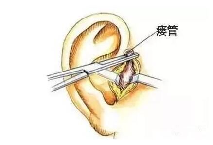 耳前瘘管手术可以报农医保吗 做耳朵前瘘管手术医保流程