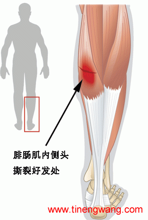 网球腿腓肠肌群损伤