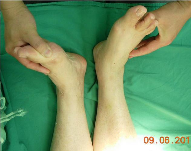 图6:股骨头坏死晚期,出现双下肢不等长.预防:1.