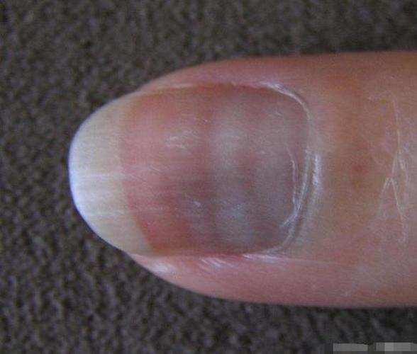 上受到了一点外伤,即使是很小的伤痛,都可能会留下手指甲上有竖纹的