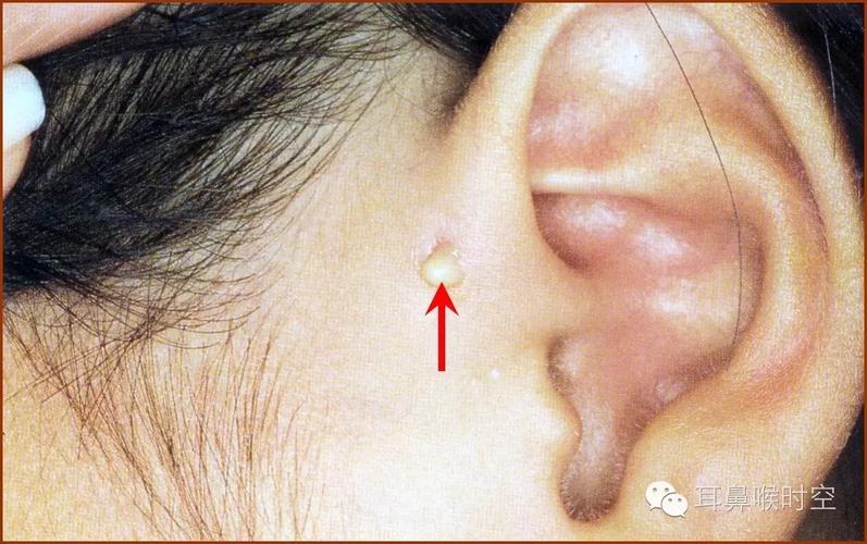 耳前瘘管_先天性耳前瘘管_症状表现_治疗方式 - 好大夫在线