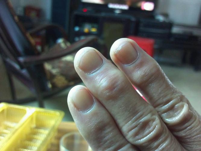 老人手指关节肿大,日益严重,请问这是关节炎吗? 该怎么治疗?