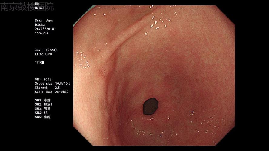 胃角前壁可见一片状糜烂,表面充血(图1)
