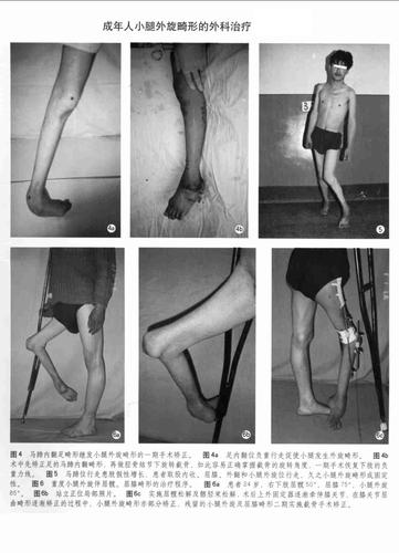 成年人小腿外旋畸形的外科治疗