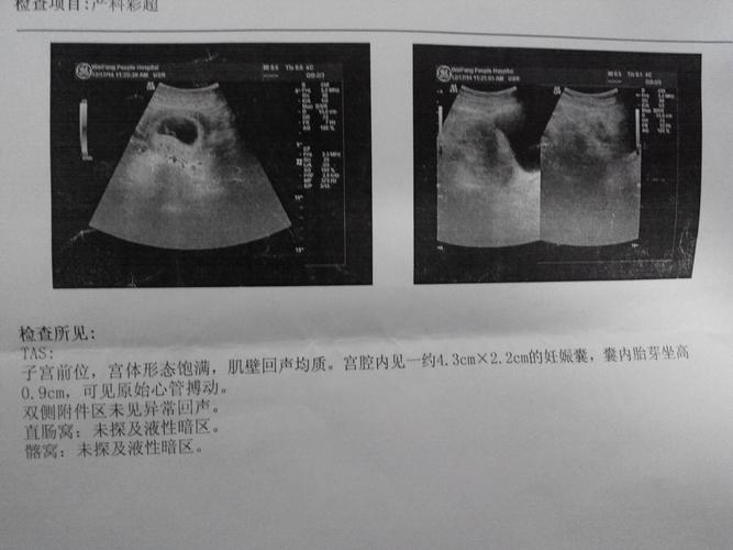     怀孕52天做b超显示孕囊4.3*2.