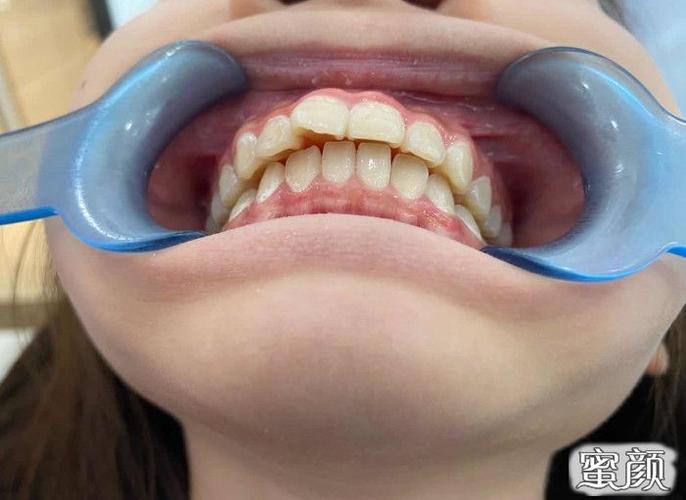牙套入学 | 牙齿矫正日记:龅牙/凸嘴学生党的牙齿矫正之路