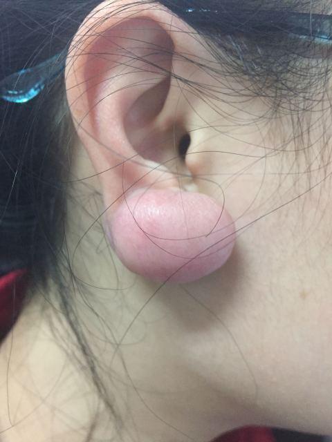 这就是瘢痕疙瘩…打耳洞之后如何避免感染?