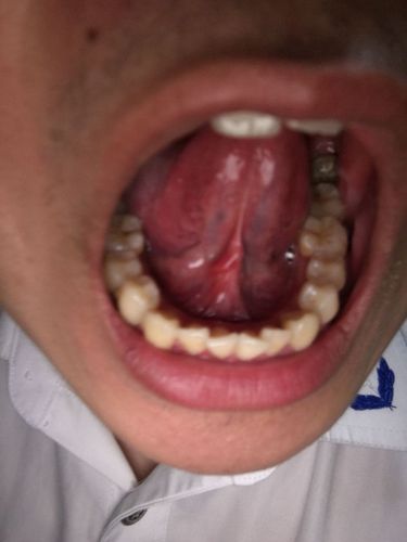 舌系带红肿怎么回事,隐隐约约的疼