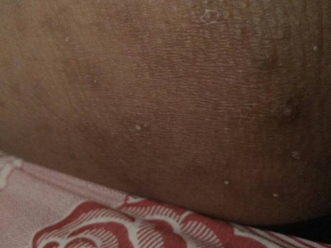 大家快看,我家宝宝的大腿根部长出一些发黑的痘痘,皮肤层里还有一片黑
