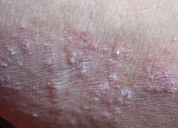 出现细小淡红色丘疹的症状是初期尖锐湿疣吗