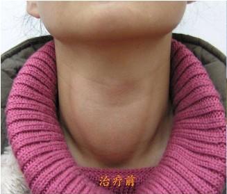 最近脖子变粗的情况越来越严重?是甲状腺结节吗?