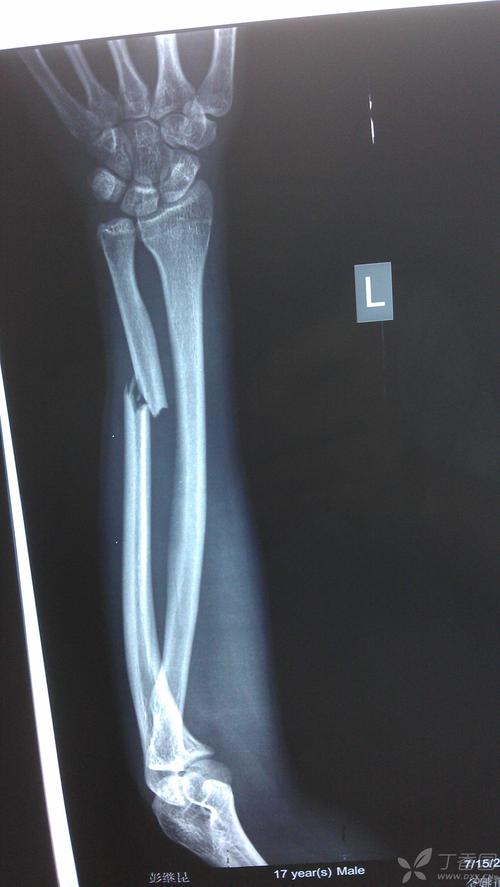 x线前臂长骨骨折判断左右的方法