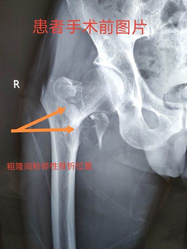 蔚县人民医院骨科近期完成三例超高龄股骨粗隆间粉碎性骨折手术 - 美
