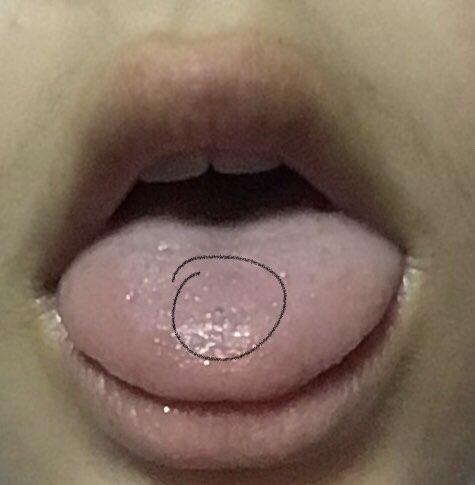 舌头上这样的黑点正常吗