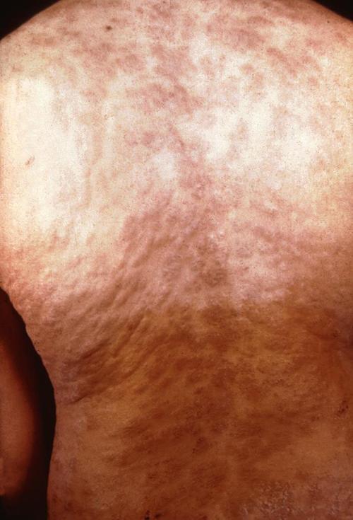梅毒——二期:背部皮疹