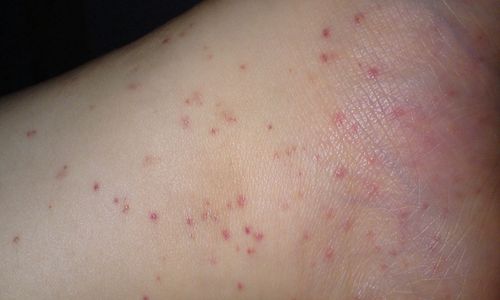 梅毒感染发病初期的症状特征图片