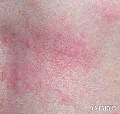 红斑样皮疹是什么了解红皮疹的主要表现症状