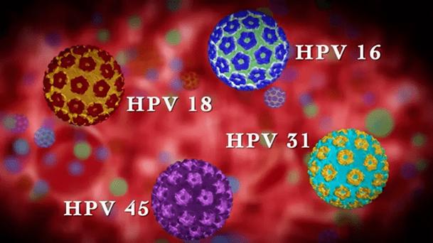 高危型hpv病毒持续感染引发的女性颈癌,不少人以为hpv感染只有可能会