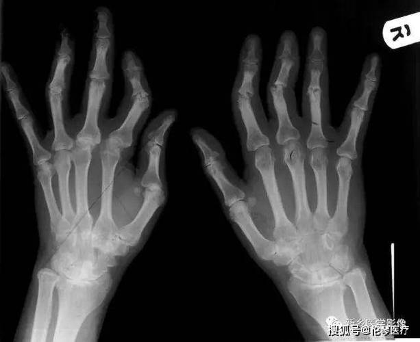 类风湿性关节炎x线图像双手多个指间关节及掌指关节间隙变窄,关节面