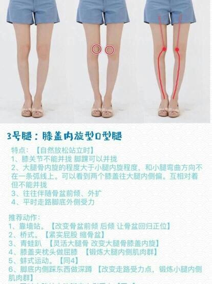 特点:膝关节不能并拢脚踝可以并拢,大腿骨内旋的程度大于小腿内旋程度