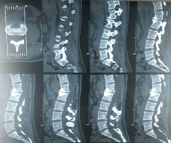 腰椎ct可见手术节段后方骨性结构:棘突,椎板及部分关节突被切除,脊柱
