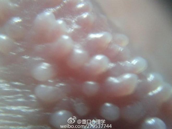 珍珠疹(hirsuties papillaris genitalis),又称为阴茎珍珠样丘疹病