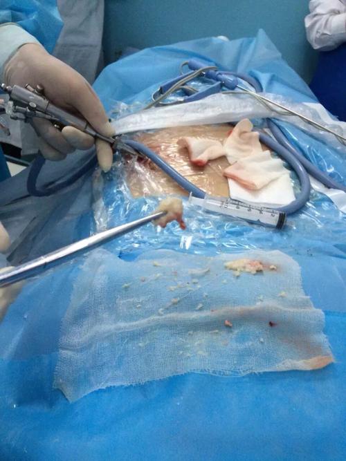 椎间盘微创手术—椎间孔镜