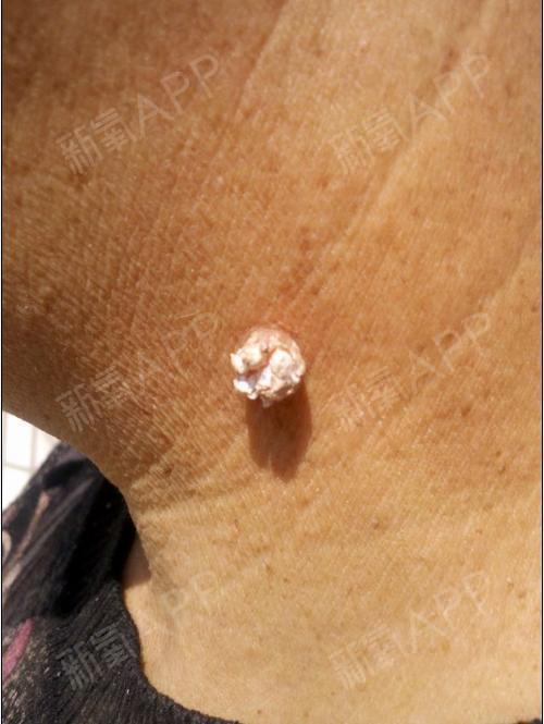 假性疣高清图片皮肤瘤有哪几种图片小息肉状假性疣图片人乳头瘤病毒