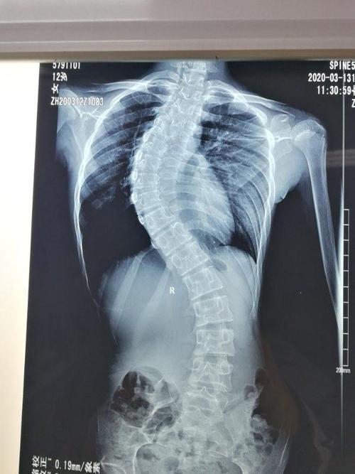 12岁女孩脊柱侧弯曲超过60度,手术矫正后"长高"4厘米