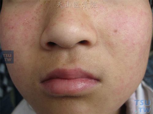 风疹(rubella,german measles)症状表现