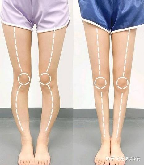 正骨能改善xo型腿吗需要根据畸形程度